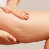 Cellulite Treatments
