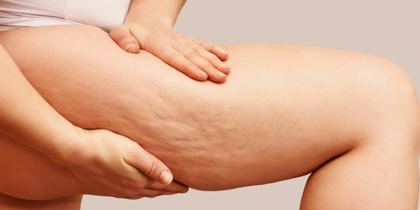 Cellulite Treatments
