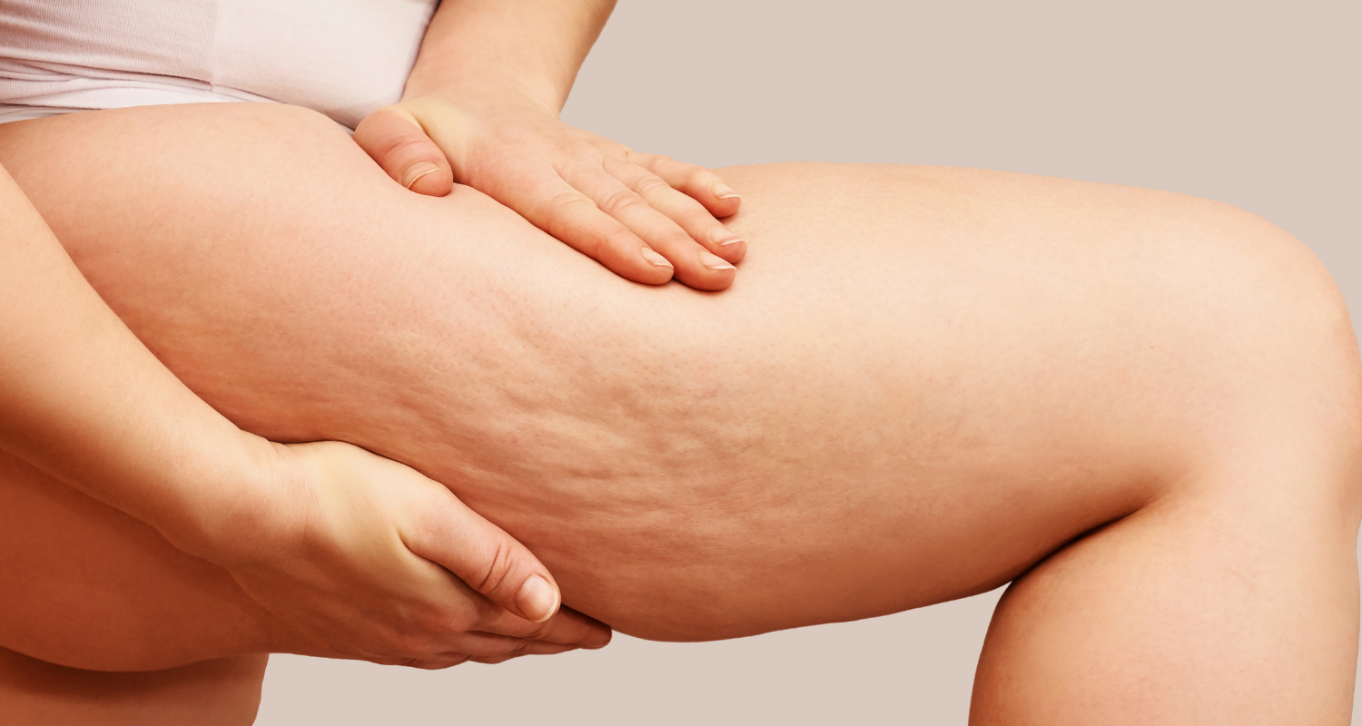 Cellulite Treatments