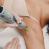 Laser Hair Removal Treatment